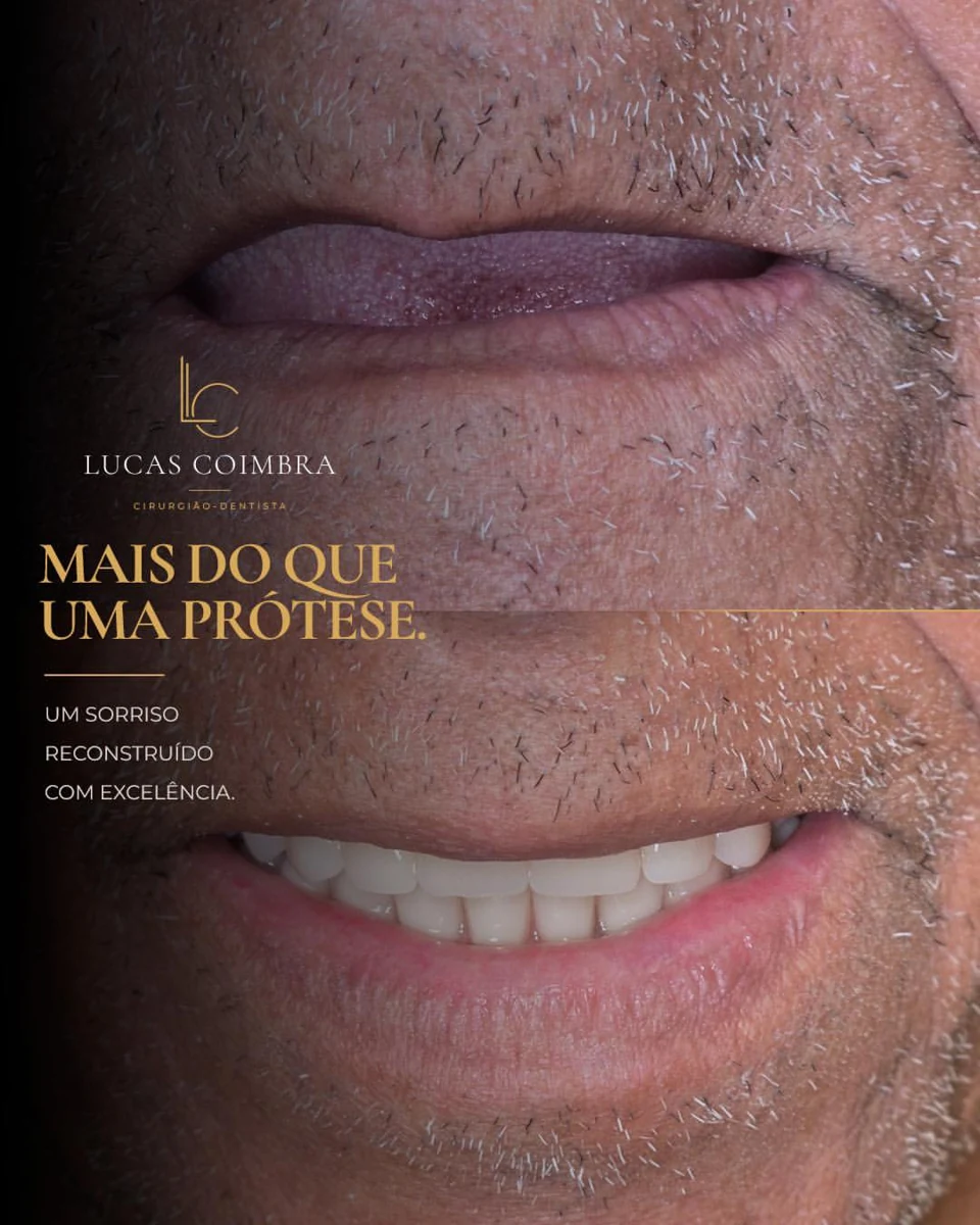 Registro clínico de reabilitação com prótese mostrando o sorriso