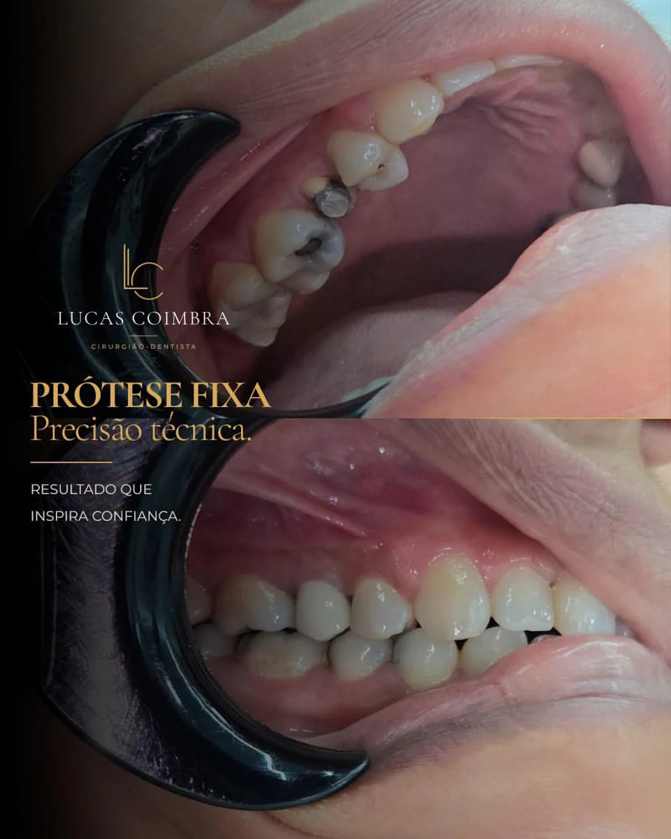 Registro clínico de prótese fixa realizado pelo Dr. Lucas Coimbra