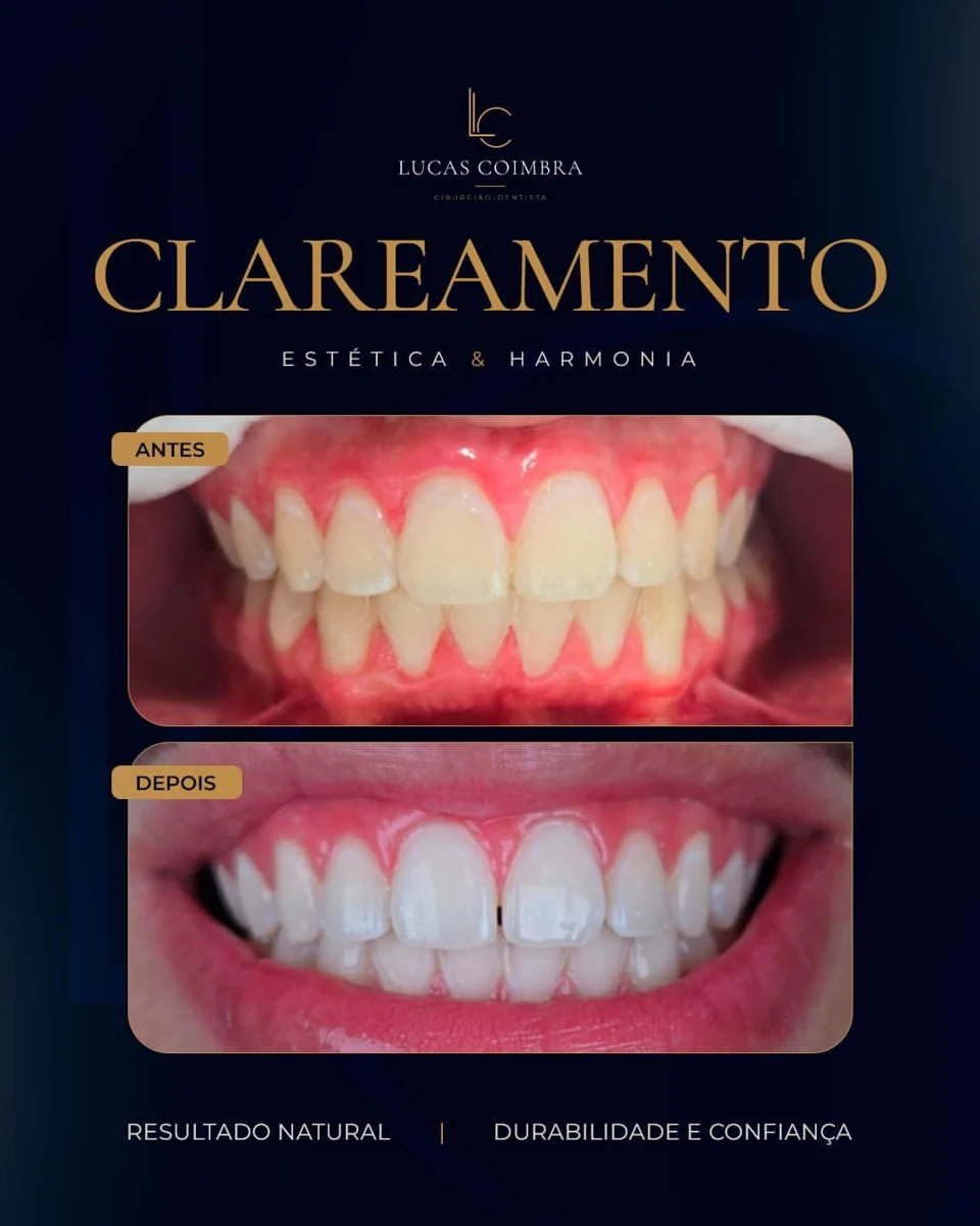 Registro clínico de clareamento dental realizado pelo Dr. Lucas Coimbra