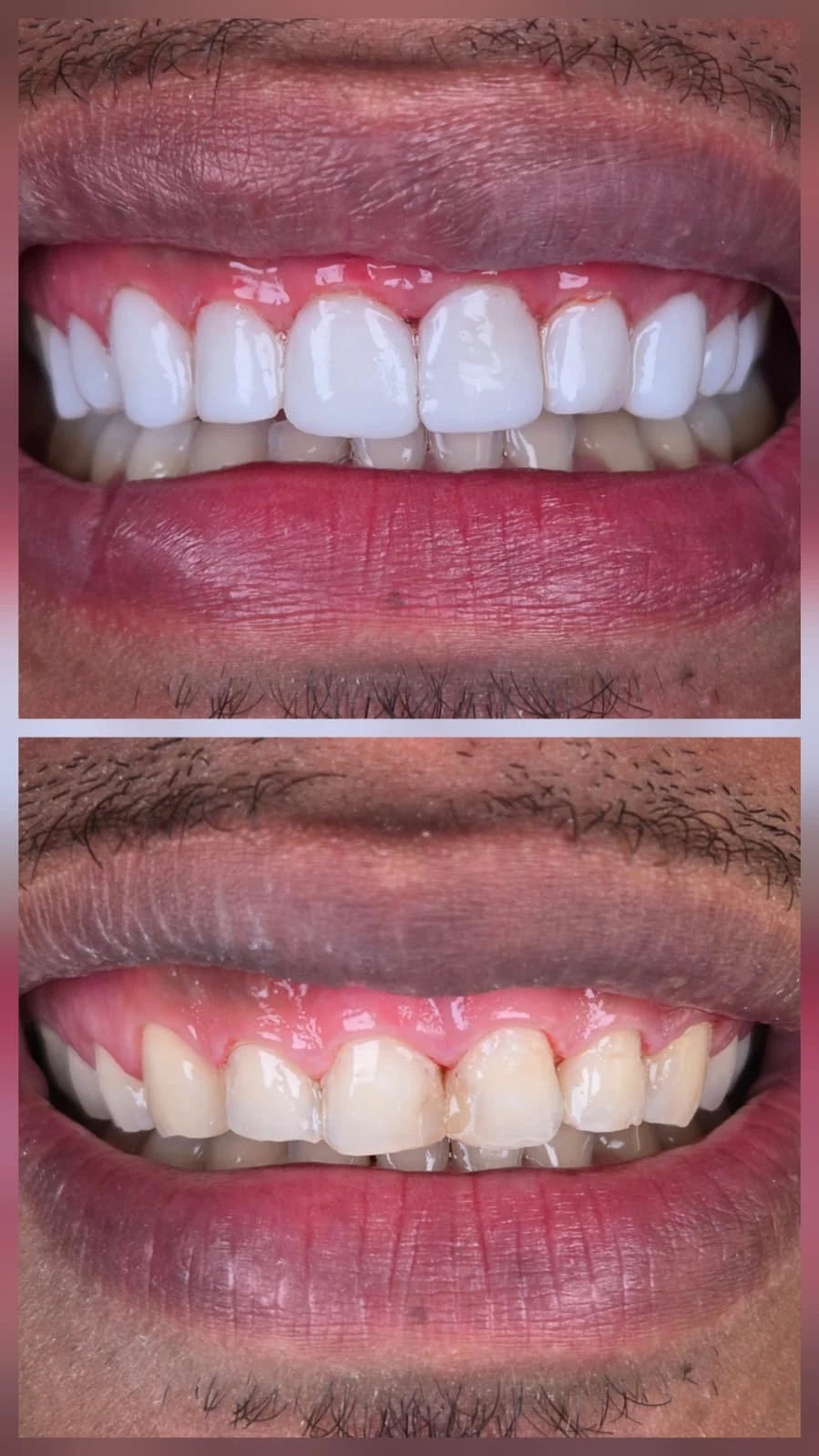 Comparativo clínico de sorriso enviado pelo Dr. Lucas Coimbra